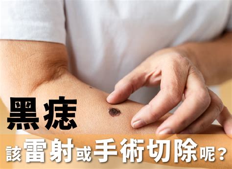 陰囊 黑痣|手術切除還是其他方法？陰莖黑痣、陰囊和包皮痣的處理方式